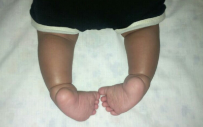 [VIDEO] Clubfoot Project