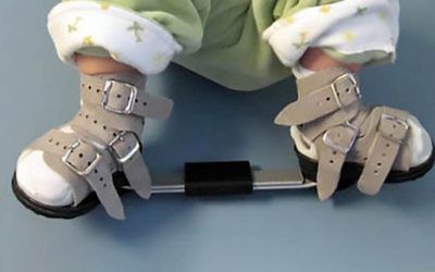 Clubfoot, a birth deformity that can be treated without major surgery